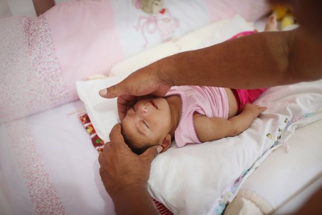 Một em bé mắc chứng đầu nhỏ liên quan đến virus zika. (Nguồn: Reuters)