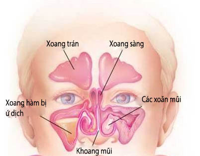  Vị trí dễ bị viêm xoang ở trẻ.