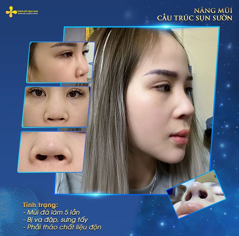 Tâm lý vui vẻ, bổ sung đầy đủ dưỡng chất cho cơ thể trước khi nâng mũi