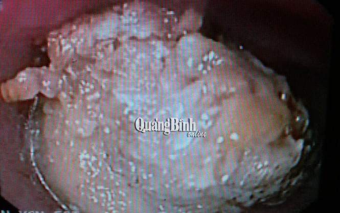 Suýt chết nghẹn vì miếng thịt heo