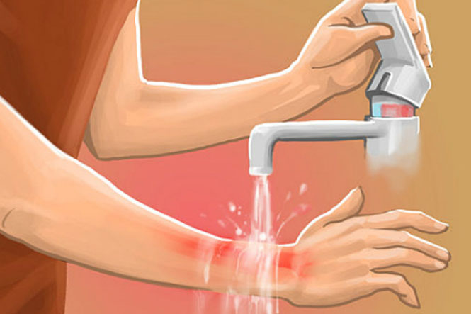Có nên rắc bột kháng sinh lên vết bỏng?