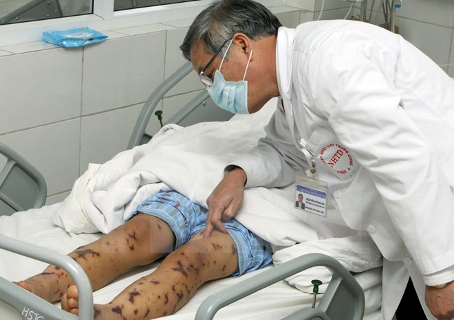 Phát hiện ca nhiễm não mô cầu nguy hiểm đầu tiên tại Hà Nội