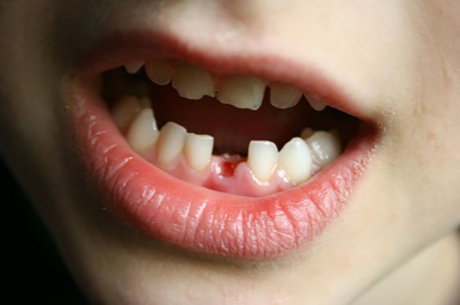 Sai lầm cần tránh khi hiểu sai về răng sữa