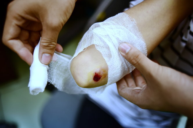 Đừng chủ quan với vết thương nhỏ