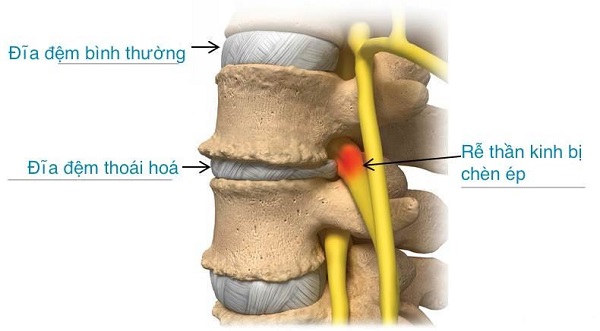 Trị đau thắt lưng thấp có nguồn gốc đĩa đệm