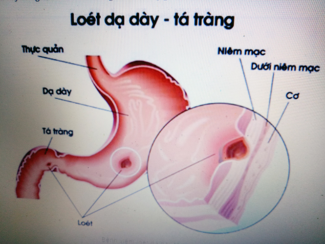 Đông y điều trị bệnh viêm loét dạ dày- tá tràng