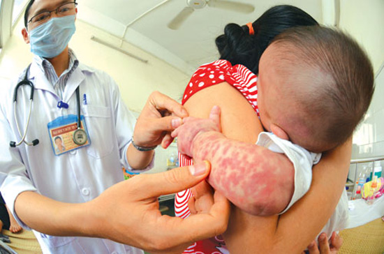 Việc cần làm khi trẻ sốt phát ban