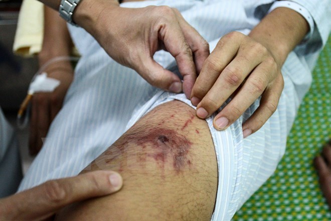 Thêm một bệnh nhân tử vong do sốt xuất huyết ở Hà Nội
