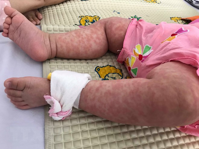 Cảnh báo bệnh sởi đang có chiều hướng gia tăng mạnh và sớm