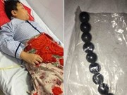 Một bệnh nhi bị hoại tử ruột do nuốt 9 viên bi nam châm