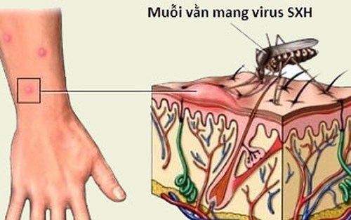 Những điều cần tránh khi điều trị SXH tại nhà