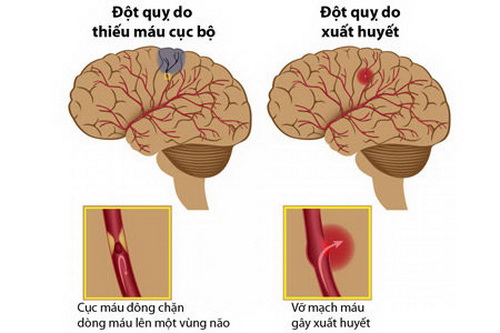 Nhận biết cơn thiếu máu não cục bộ thoáng qua