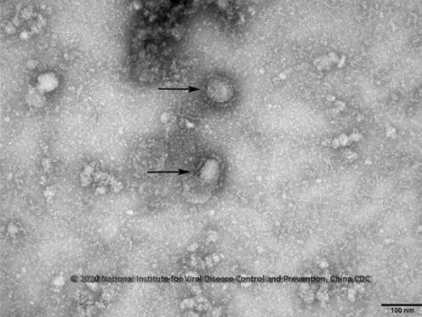 Hướng dẫn chẩn đoán và điều trị bệnh phổi do chủng virus Corona mới