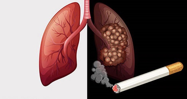 90% bệnh nhân ung thư phổi do hút thuốc lá