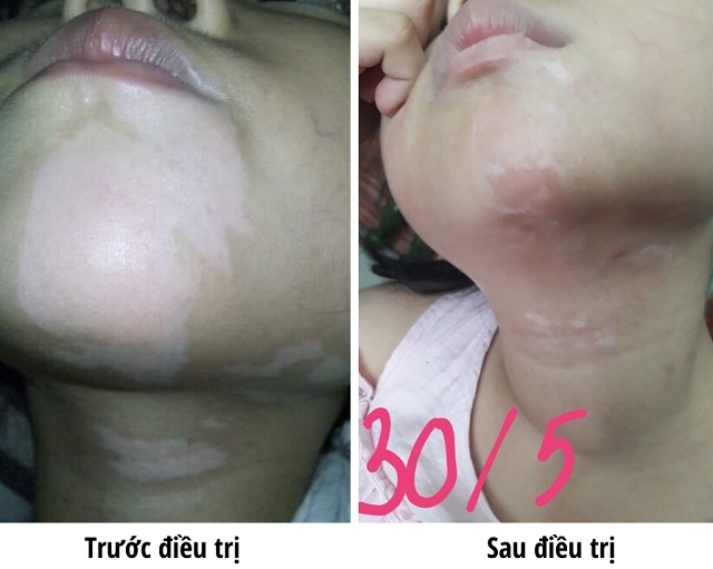Đã có phương pháp mới điều trị bệnh bạch biến hiệu quả đến 80%