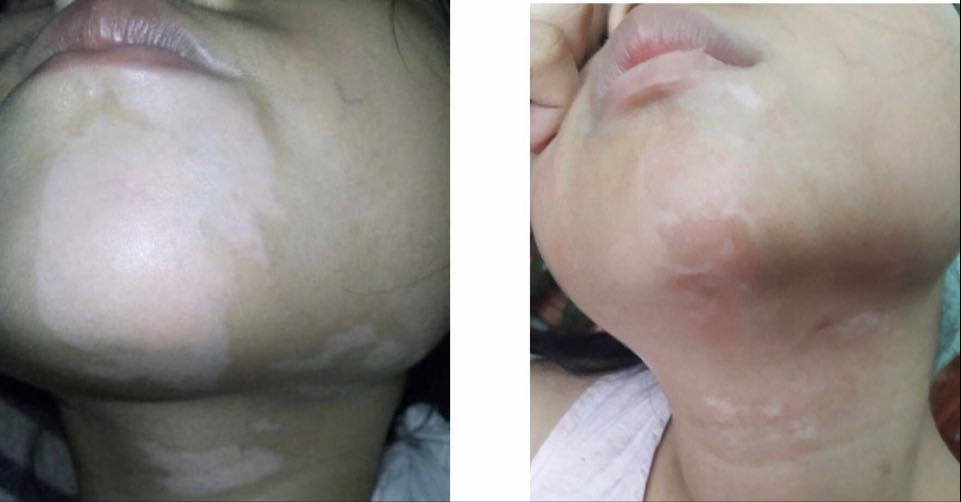 Nhận thức đúng về bệnh bạch biến để điều trị hiệu quả
