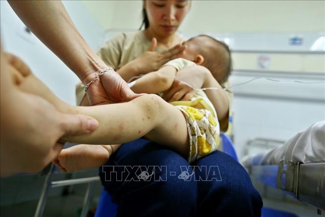 Các cơ sở y tế sẵn sàng tiếp nhận và điều trị bệnh tay chân miệng