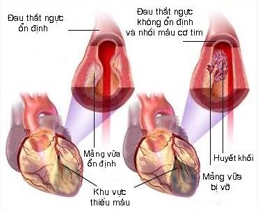 Nguy cơ nhồi máu cơ tim từ những cơn đau thắt ngực