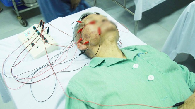 Cảnh giác tránh bị liệt mặt, méo miệng khi trời lạnh