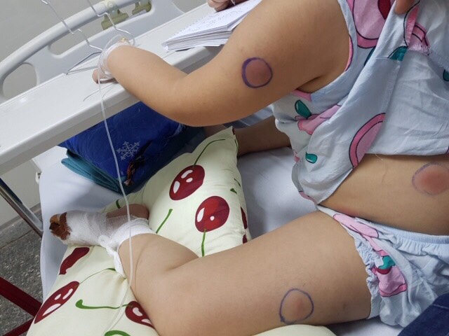 Bị gà mổ vào chân, bé 6 tuổi bị nhiễm vi khuẩn "ăn thịt người"