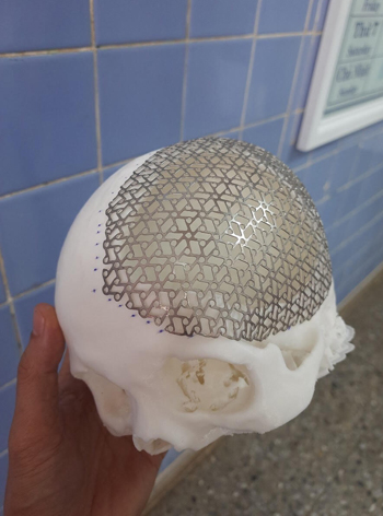 Phẫu thuật ghép khuyết sọ bằng tấm titanium được tạo hình 3D