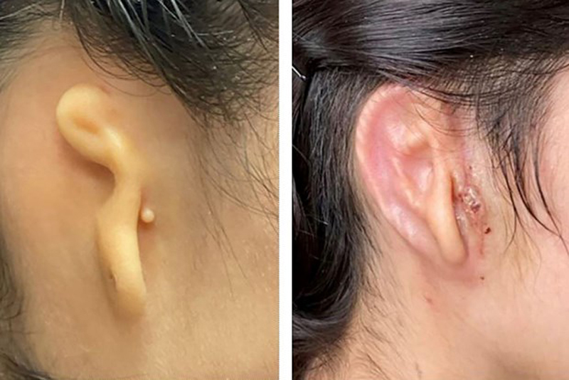 Mỹ thực hiện thành công ca cấy ghép tai người sử dụng công nghệ in 3D