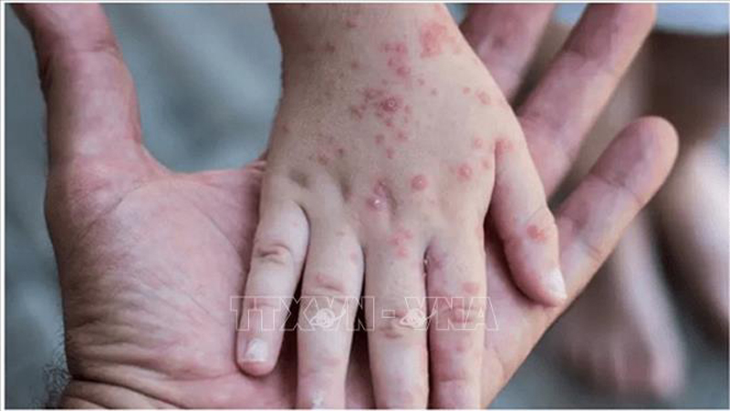 WHO: Virus gây bệnh đậu mùa khỉ tiếp tục lây lan