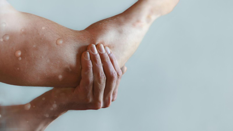 Thế giới ghi nhận 14 nghìn ca mắc bệnh đậu mùa khỉ