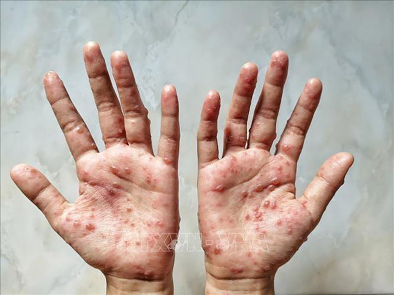 Bộ Y tế khuyến cáo người dân chủ động thực hiện các biện pháp phòng bệnh đậu mùa khỉ