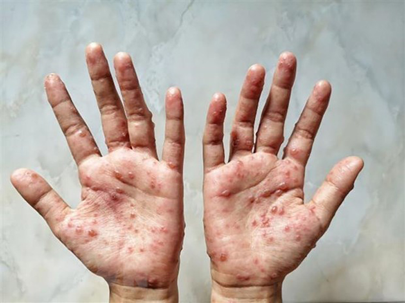 Yêu cầu tăng cường kiểm soát, phòng, chống bệnh đậu mùa khỉ