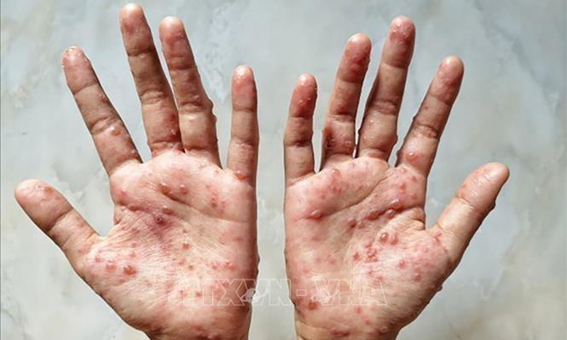 Phát hiện mới về sự lây truyền của bệnh đậu mùa khỉ