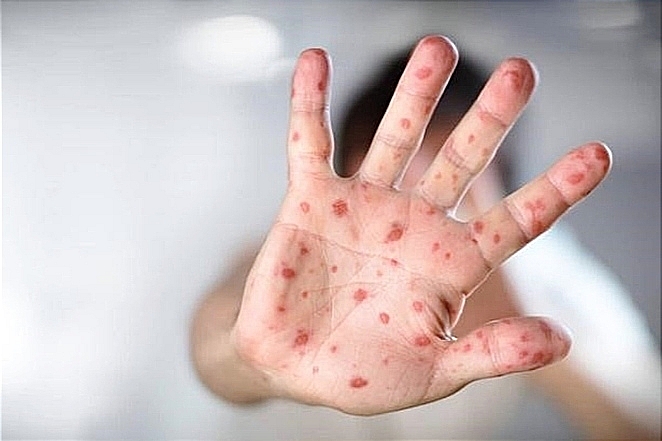 Tăng cường công tác phòng, chống dịch bệnh tay chân miệng