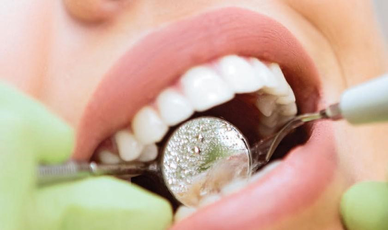 Cạo vôi răng và những điều cần biết