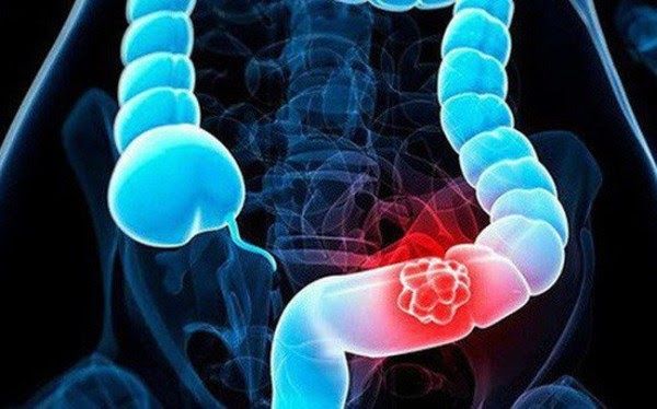 Đột phá trong nghiên cứu phát hiện sớm các khối u ung thư ruột