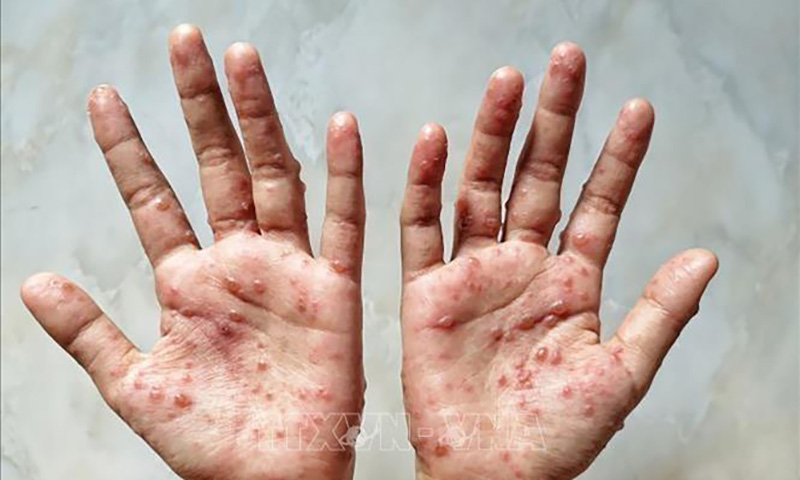 Hàn Quốc: Tăng cường kiểm soát dịch bệnh đậu mùa khỉ